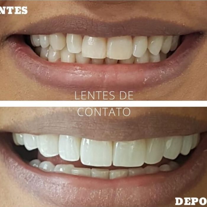 Lentes de Contato